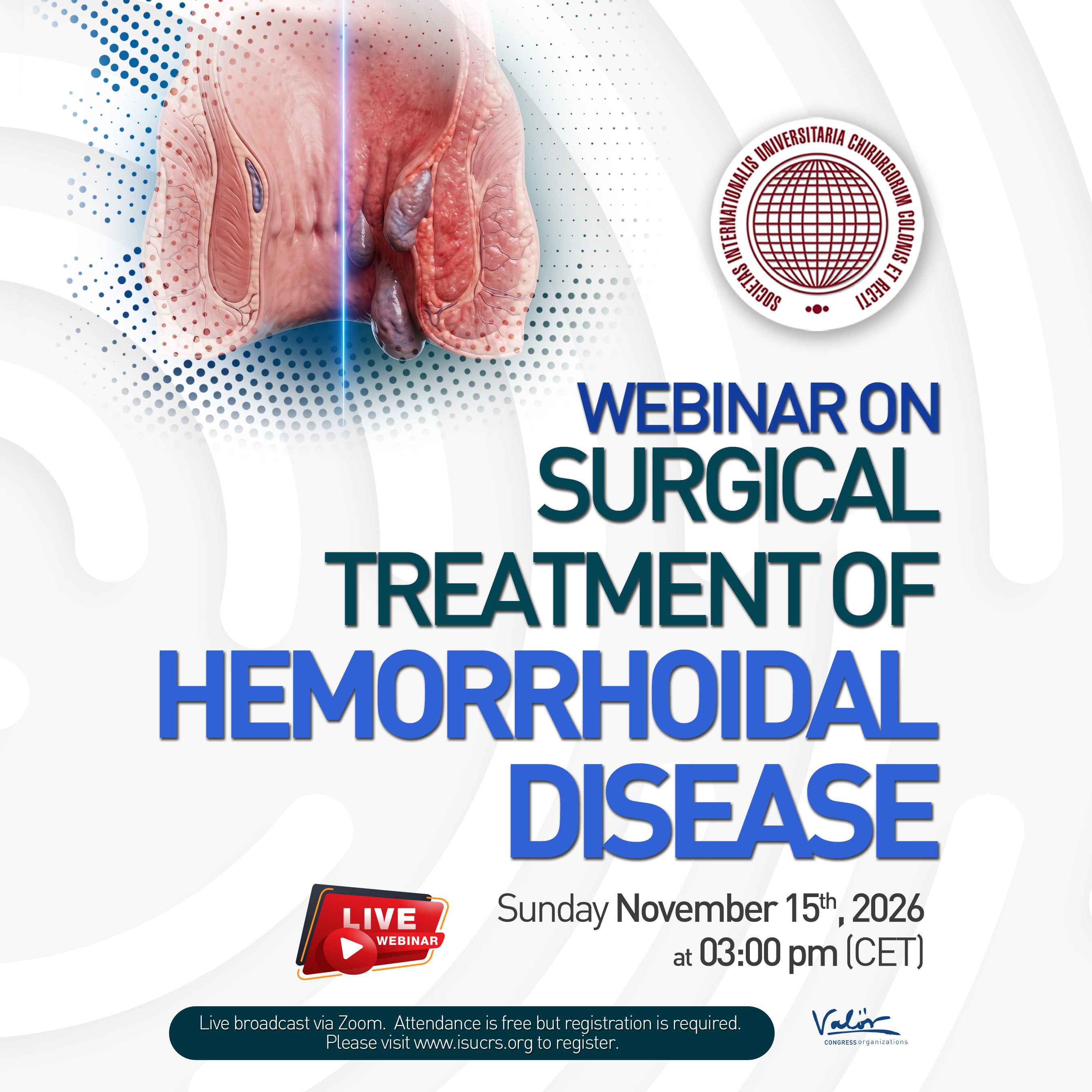 Webinar on Surgical Treatment of Hemorrhoidal Disease